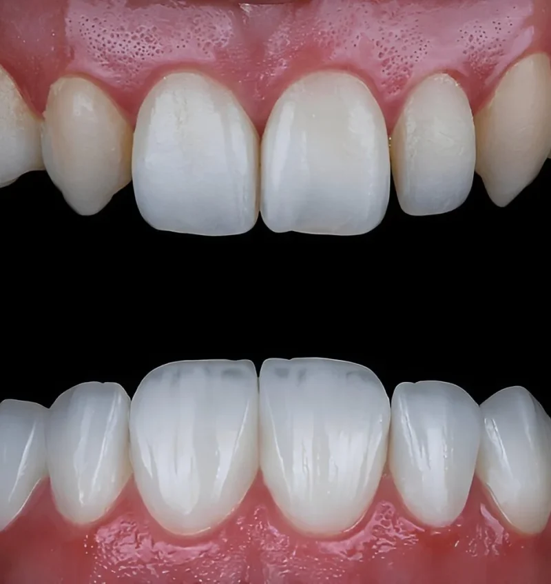 Same-day dental veneers