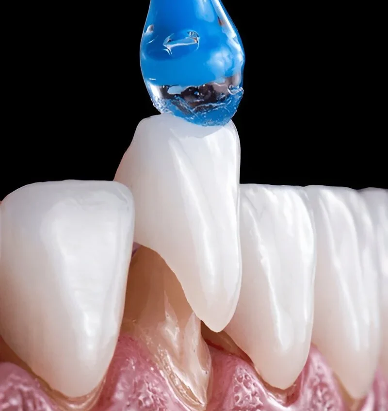 Porcelain veneers specialist